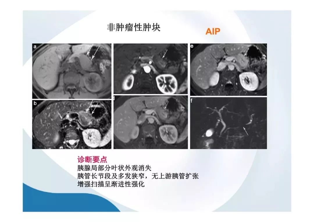 【PPT】胰腺非常见肿瘤影像学检查与诊断思路
