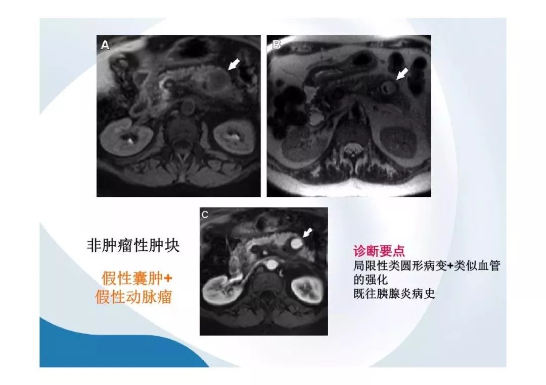 【PPT】胰腺非常见肿瘤影像学检查与诊断思路