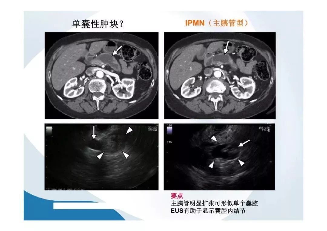 【PPT】胰腺非常见肿瘤影像学检查与诊断思路