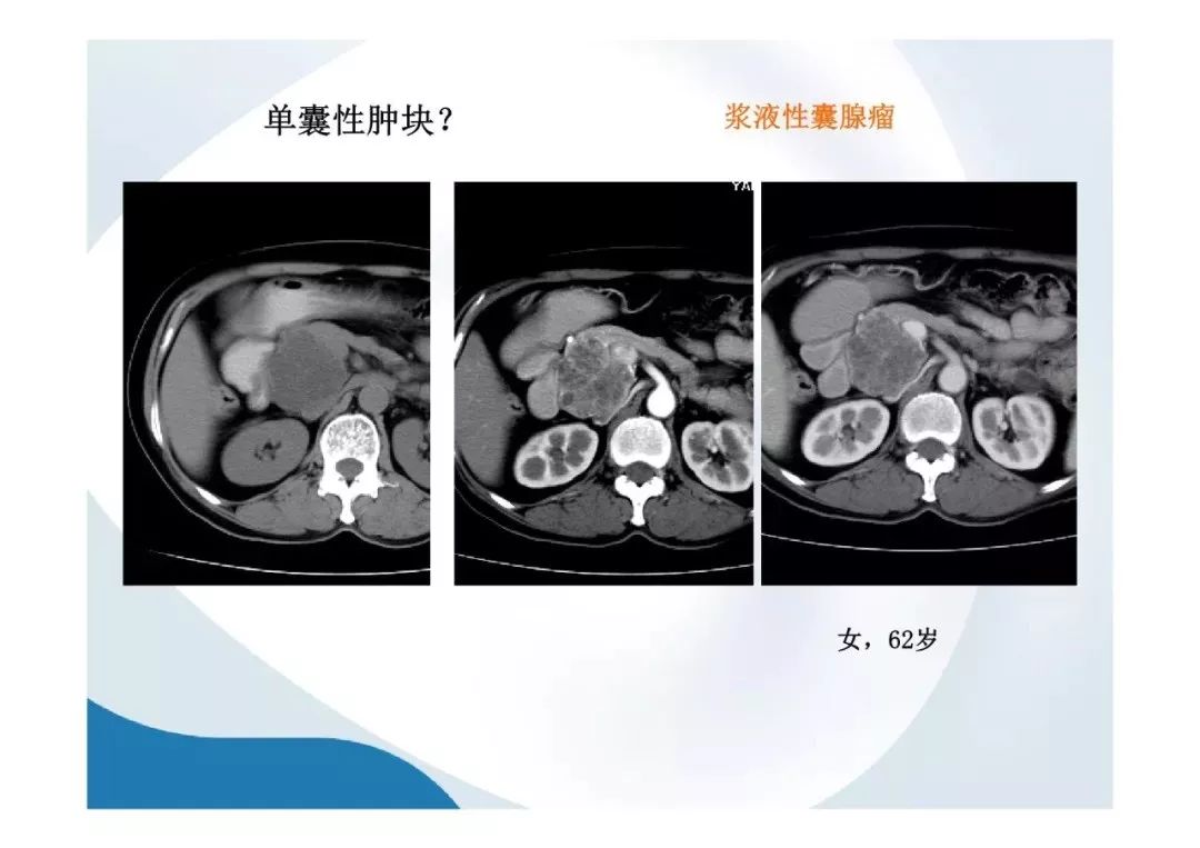 【PPT】胰腺非常见肿瘤影像学检查与诊断思路
