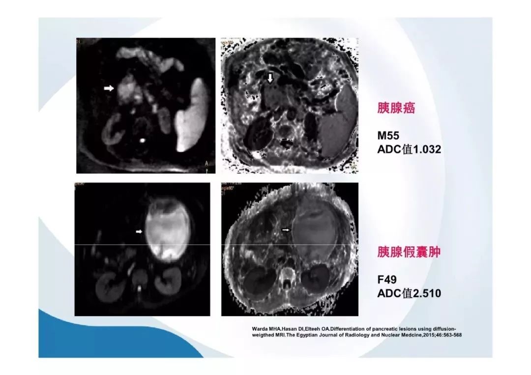 【PPT】胰腺非常见肿瘤影像学检查与诊断思路