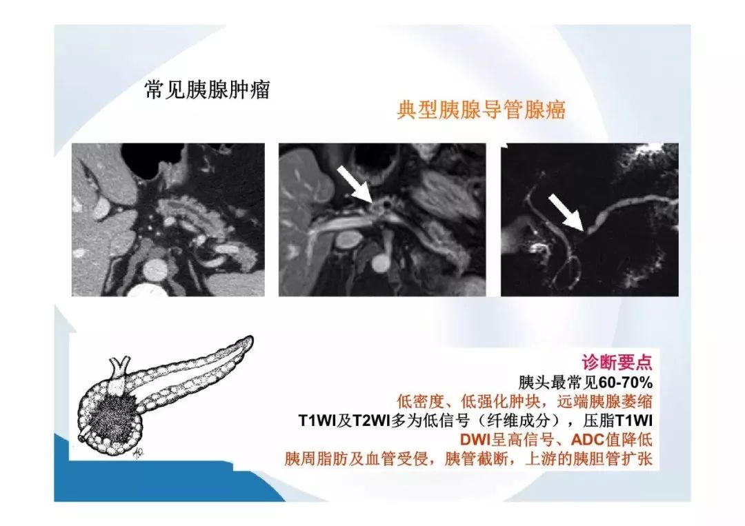 【PPT】胰腺非常见肿瘤影像学检查与诊断思路
