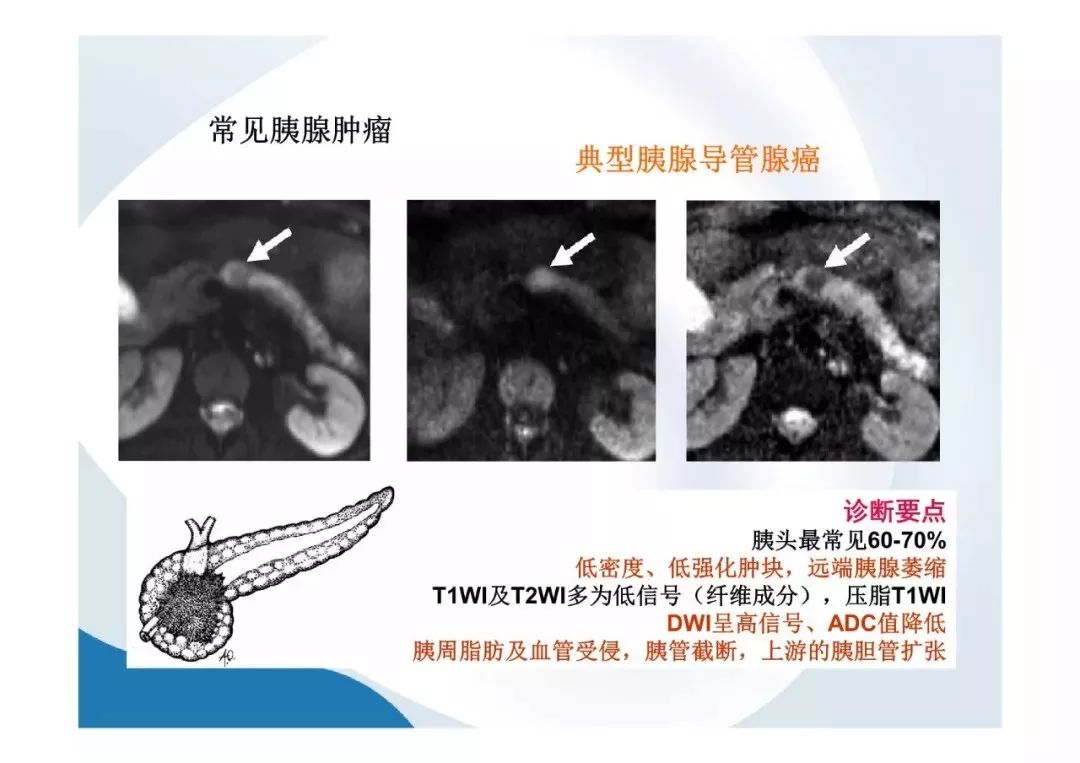 【PPT】胰腺非常见肿瘤影像学检查与诊断思路