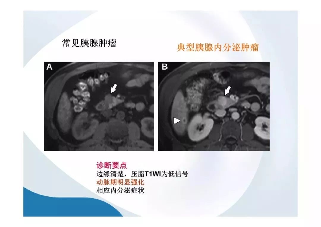 【PPT】胰腺非常见肿瘤影像学检查与诊断思路