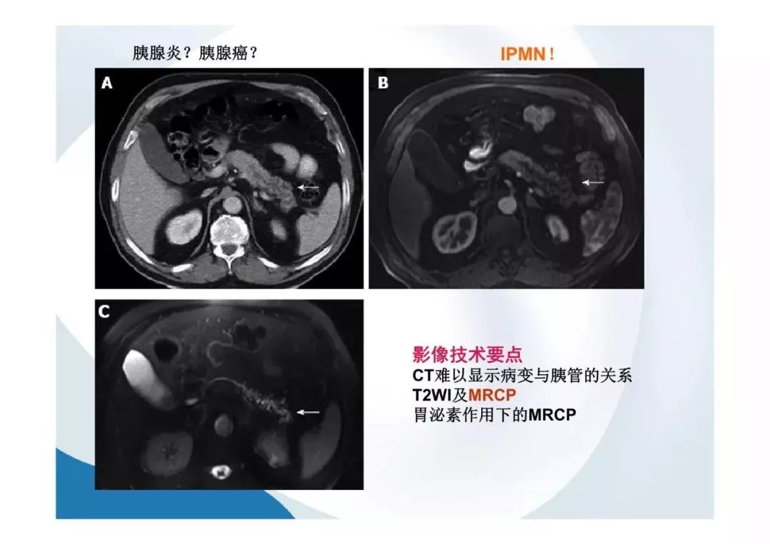 【PPT】胰腺非常见肿瘤影像学检查与诊断思路