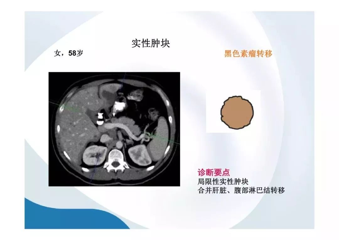 【PPT】胰腺非常见肿瘤影像学检查与诊断思路