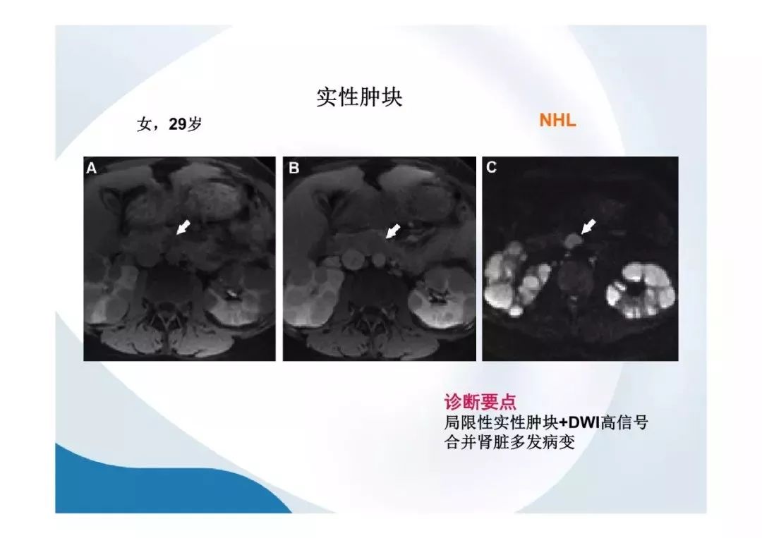【PPT】胰腺非常见肿瘤影像学检查与诊断思路