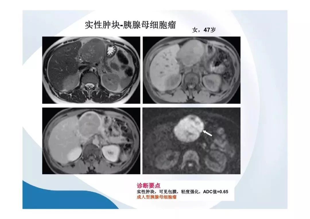 【PPT】胰腺非常见肿瘤影像学检查与诊断思路