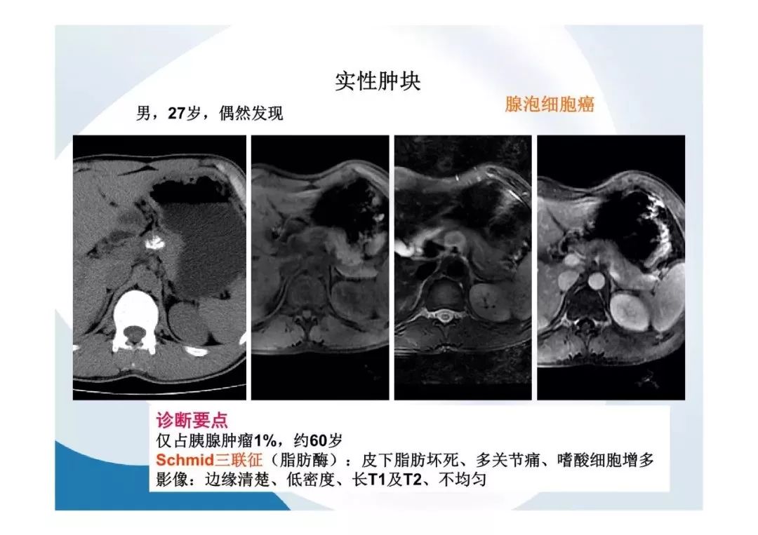 【PPT】胰腺非常见肿瘤影像学检查与诊断思路