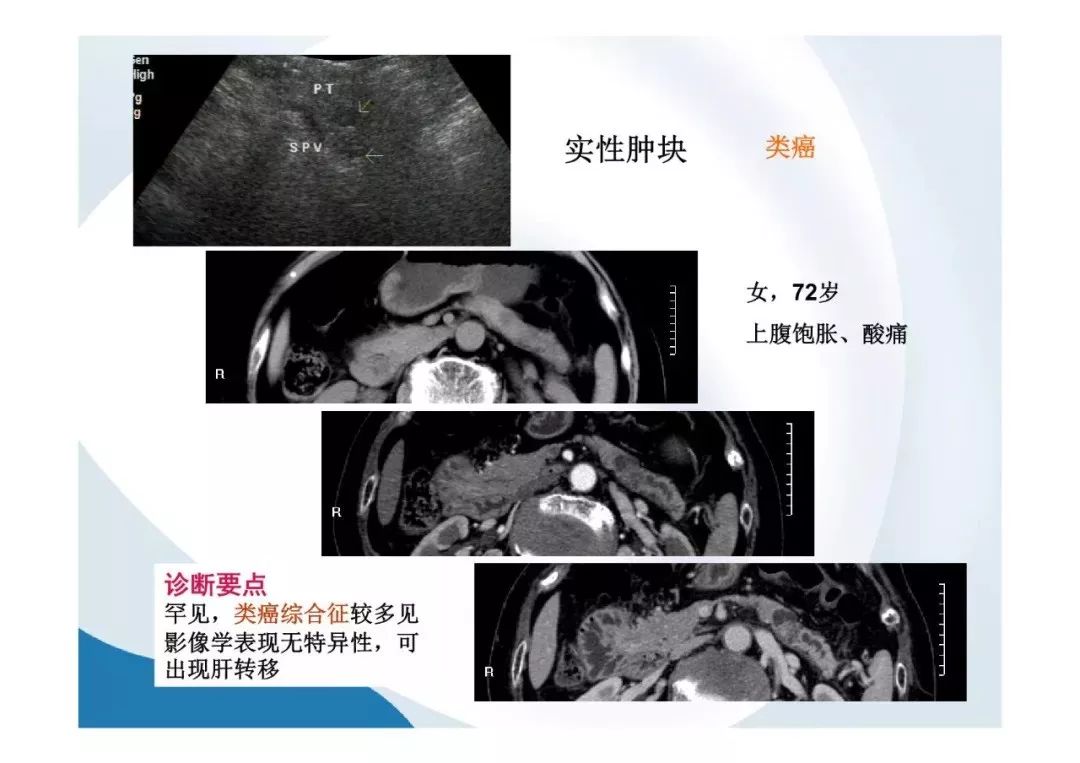 【PPT】胰腺非常见肿瘤影像学检查与诊断思路