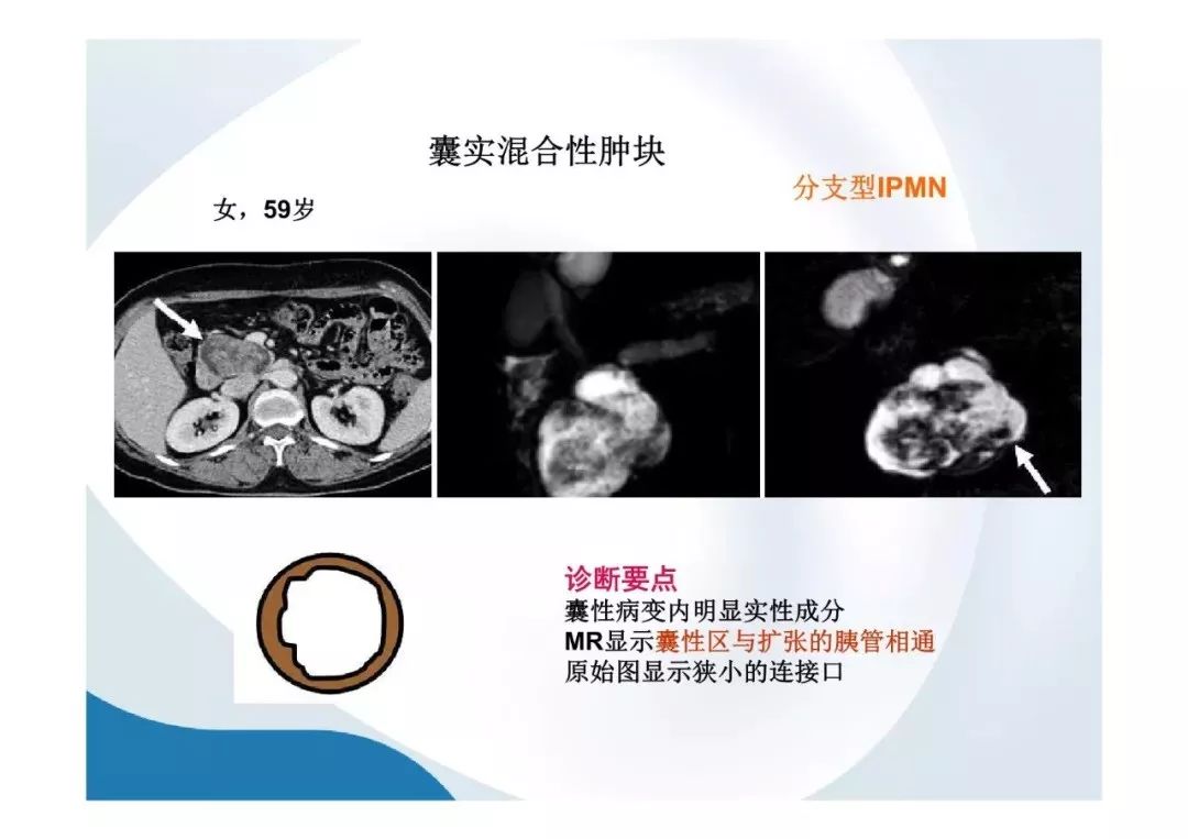 【PPT】胰腺非常见肿瘤影像学检查与诊断思路