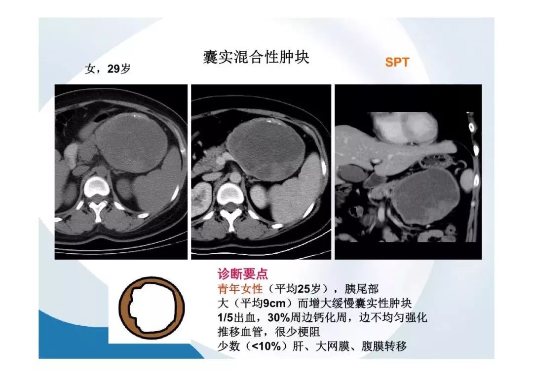 【PPT】胰腺非常见肿瘤影像学检查与诊断思路