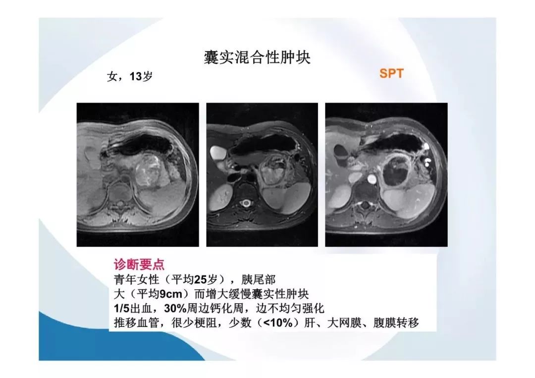 【PPT】胰腺非常见肿瘤影像学检查与诊断思路
