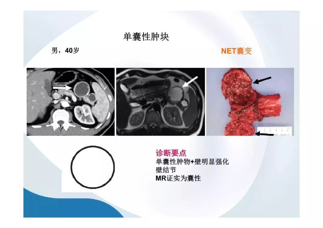 【PPT】胰腺非常见肿瘤影像学检查与诊断思路
