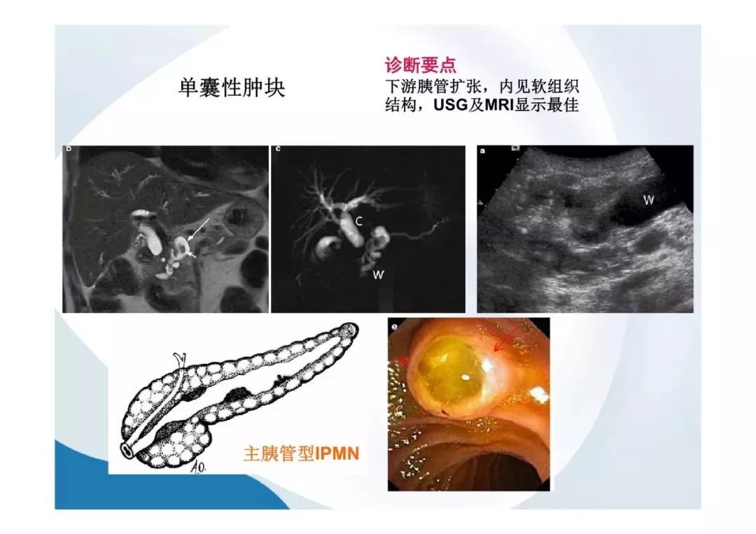 【PPT】胰腺非常见肿瘤影像学检查与诊断思路