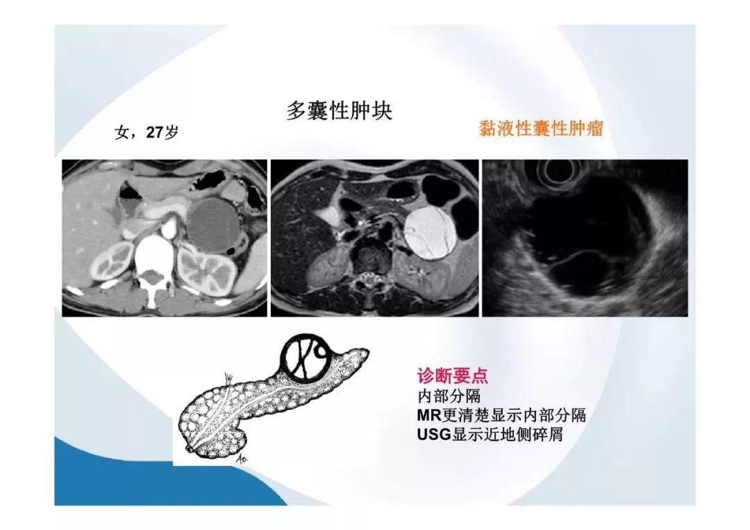 【PPT】胰腺非常见肿瘤影像学检查与诊断思路