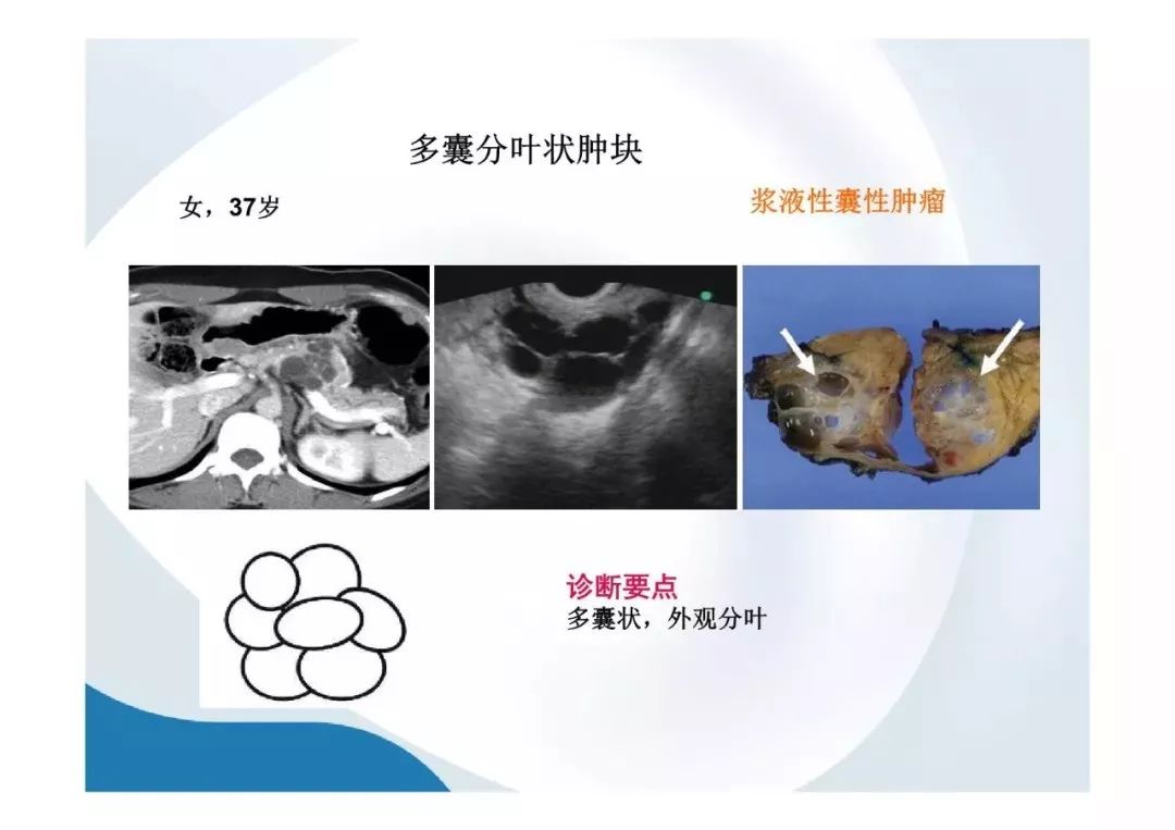 【PPT】胰腺非常见肿瘤影像学检查与诊断思路