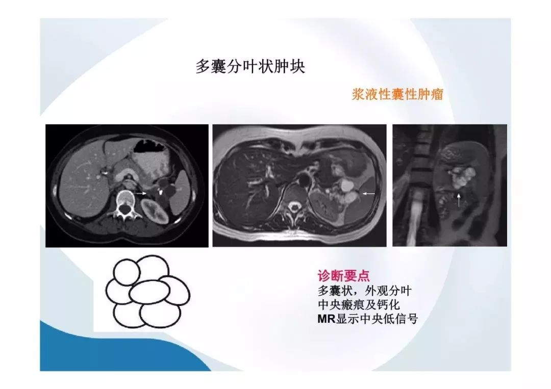 【PPT】胰腺非常见肿瘤影像学检查与诊断思路