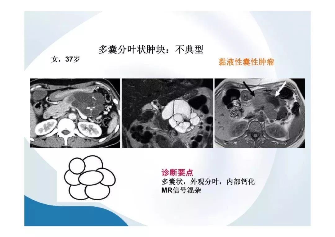【PPT】胰腺非常见肿瘤影像学检查与诊断思路