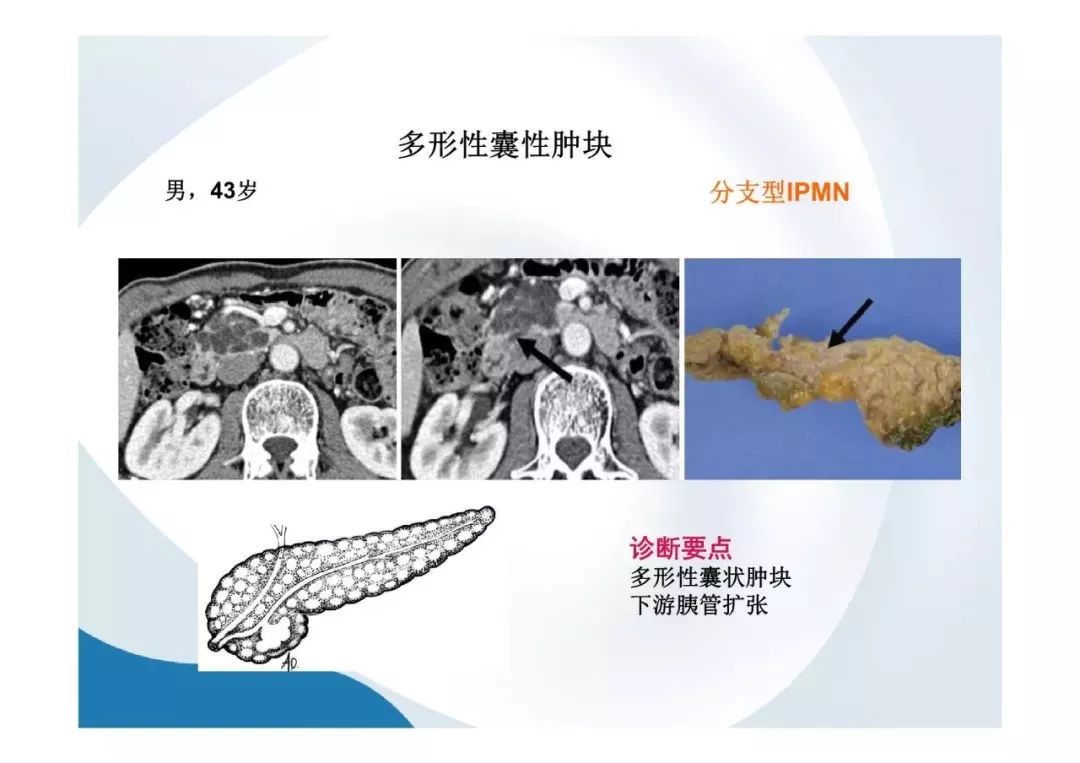 【PPT】胰腺非常见肿瘤影像学检查与诊断思路