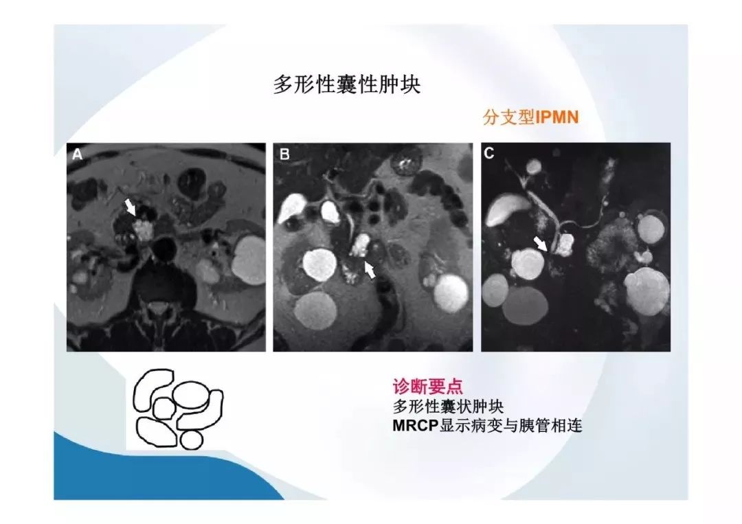 【PPT】胰腺非常见肿瘤影像学检查与诊断思路