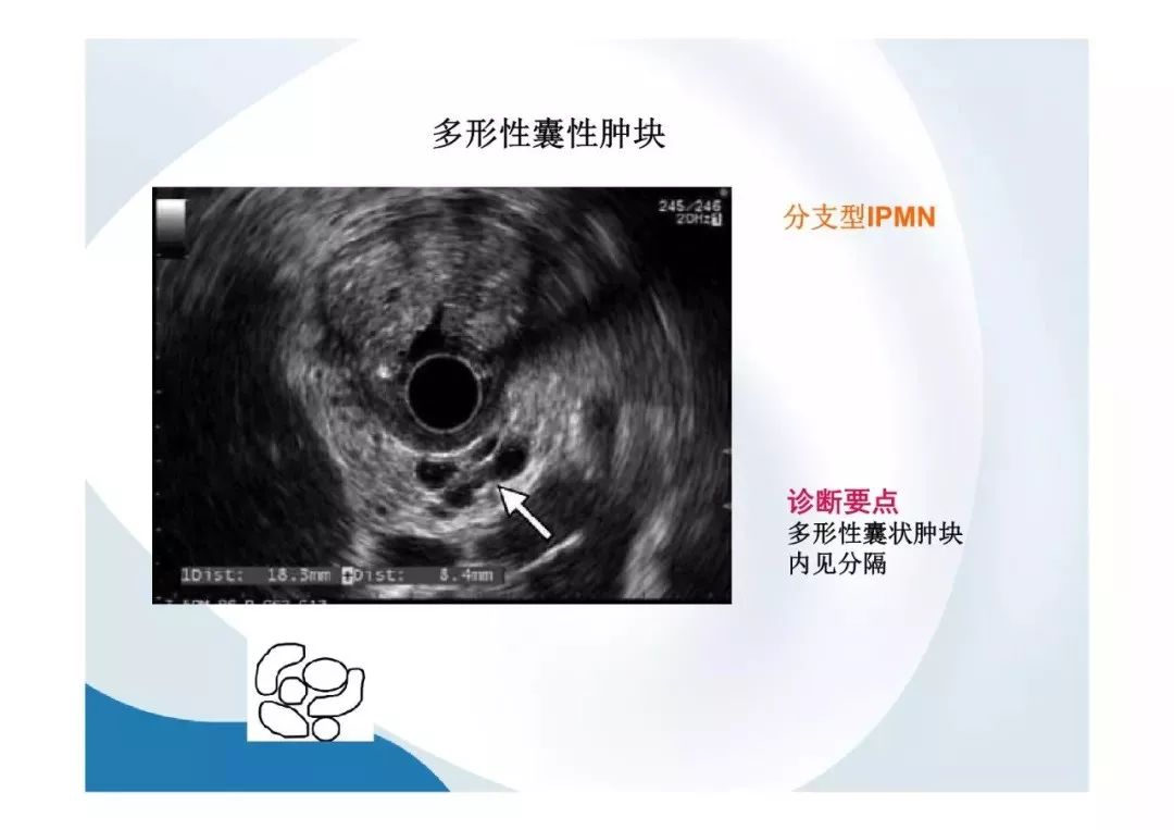 【PPT】胰腺非常见肿瘤影像学检查与诊断思路