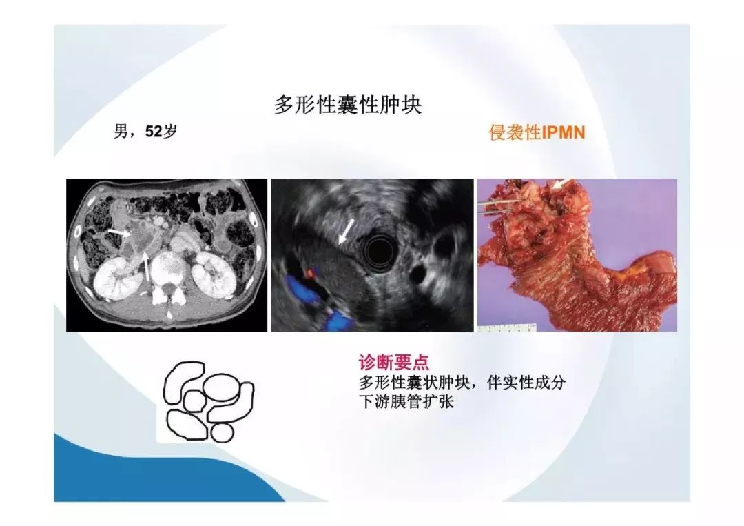 【PPT】胰腺非常见肿瘤影像学检查与诊断思路