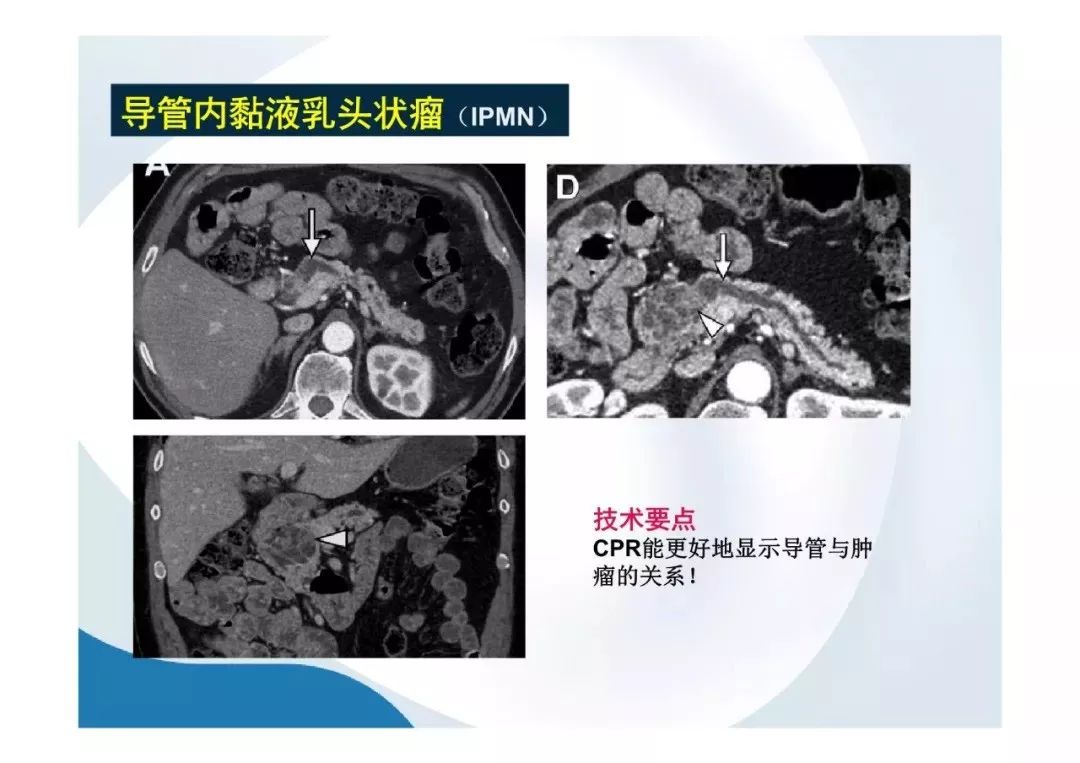 【PPT】胰腺非常见肿瘤影像学检查与诊断思路