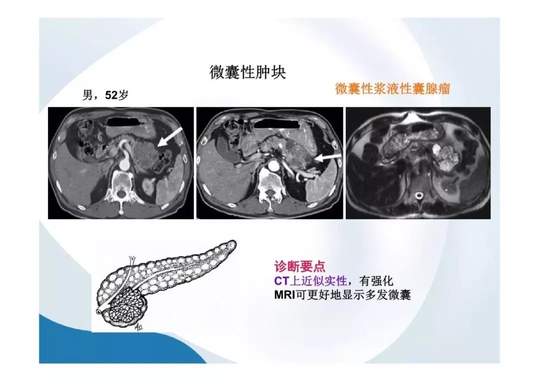 【PPT】胰腺非常见肿瘤影像学检查与诊断思路