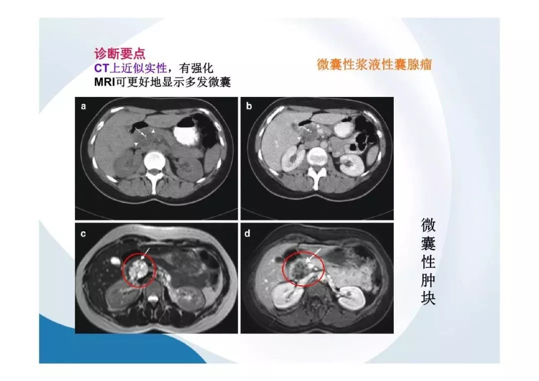 【PPT】胰腺非常见肿瘤影像学检查与诊断思路