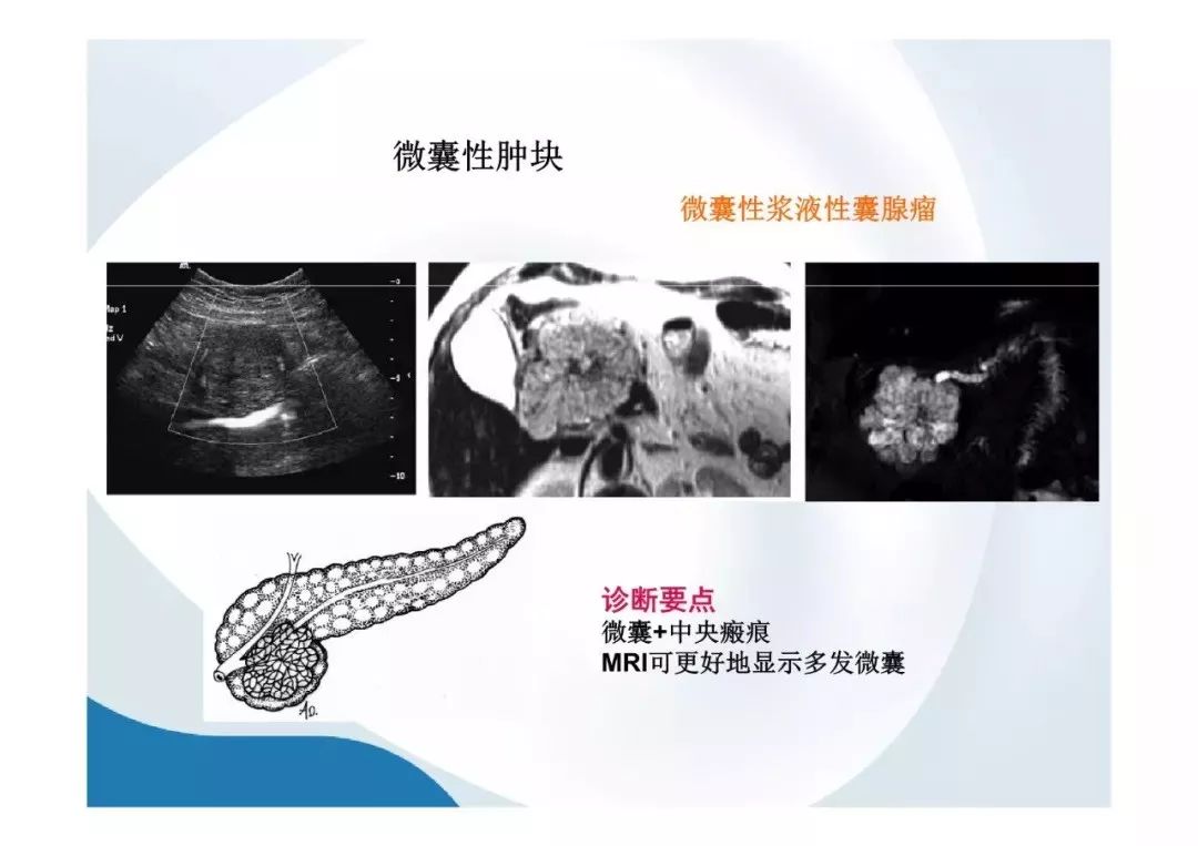 【PPT】胰腺非常见肿瘤影像学检查与诊断思路