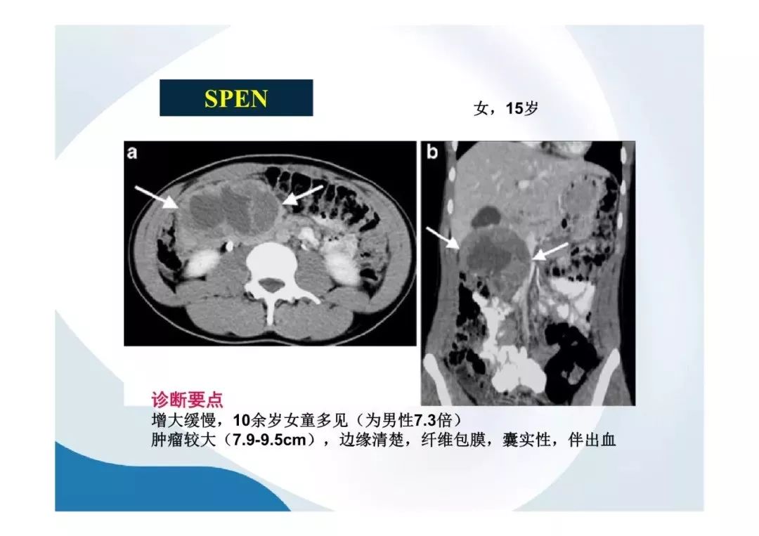 【PPT】胰腺非常见肿瘤影像学检查与诊断思路