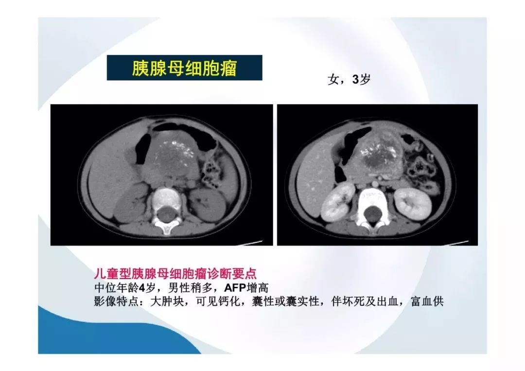 【PPT】胰腺非常见肿瘤影像学检查与诊断思路