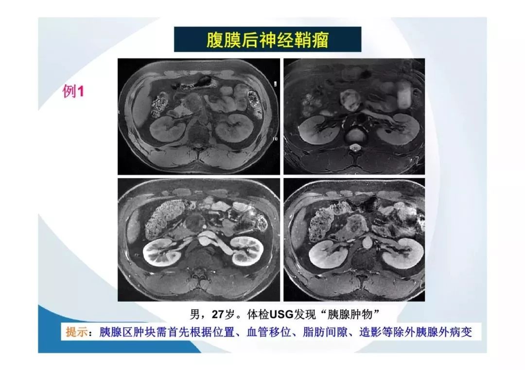 【PPT】胰腺非常见肿瘤影像学检查与诊断思路