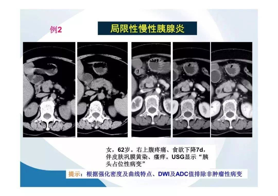 【PPT】胰腺非常见肿瘤影像学检查与诊断思路