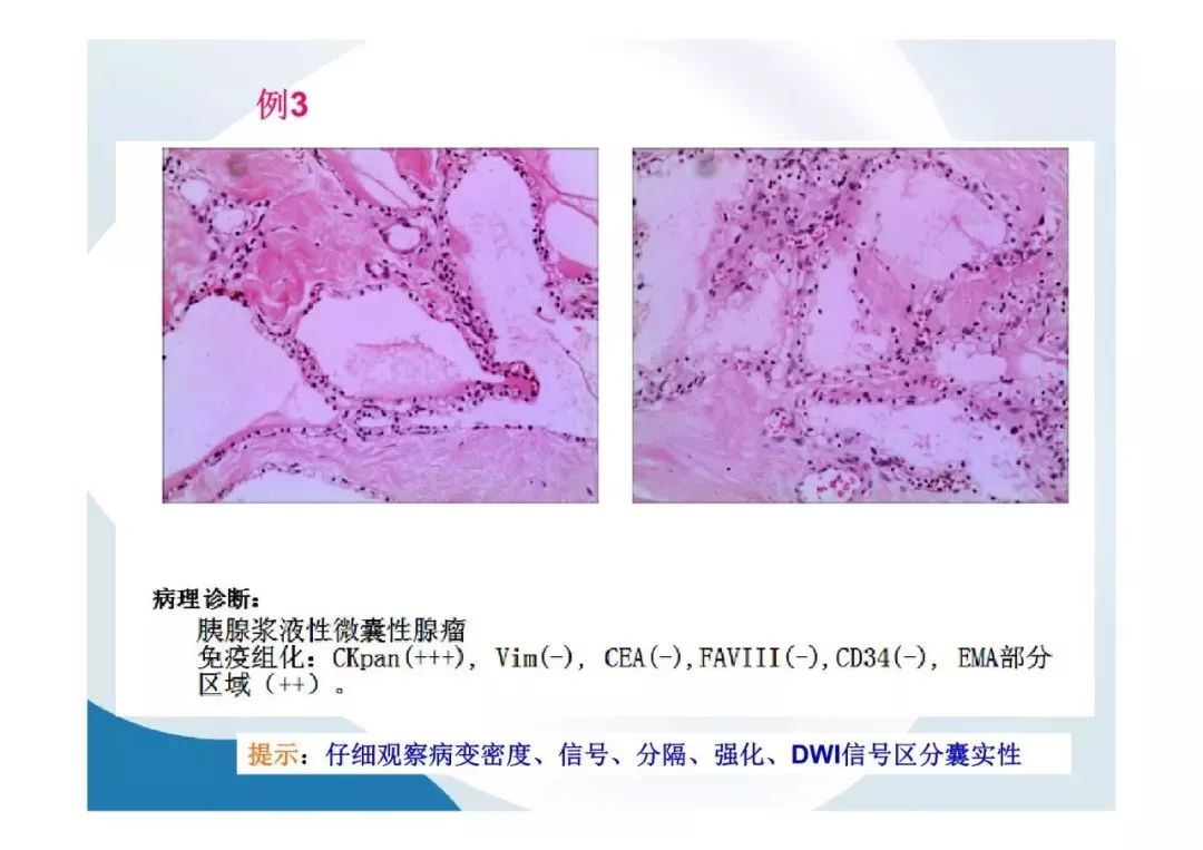 【PPT】胰腺非常见肿瘤影像学检查与诊断思路