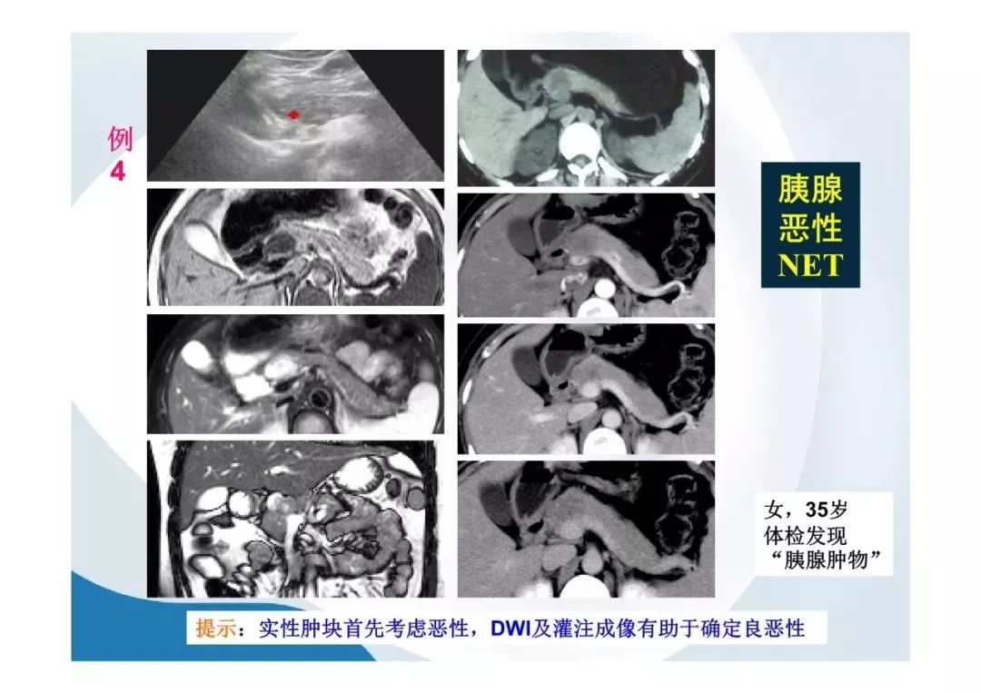 【PPT】胰腺非常见肿瘤影像学检查与诊断思路