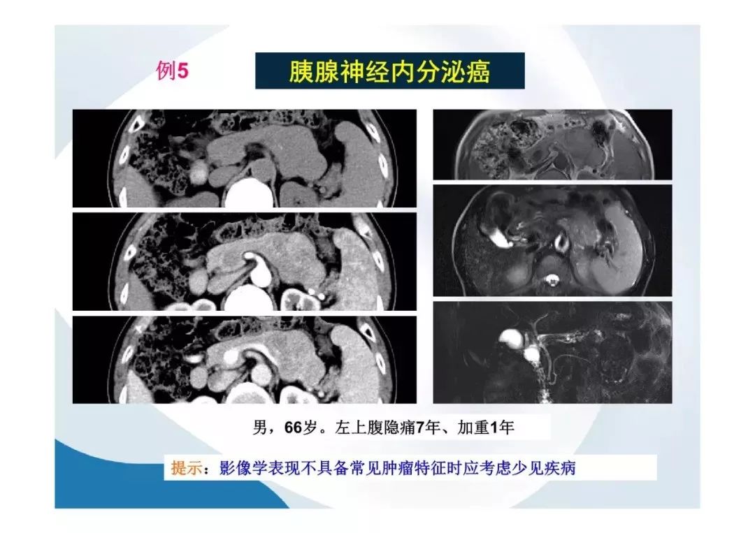 【PPT】胰腺非常见肿瘤影像学检查与诊断思路