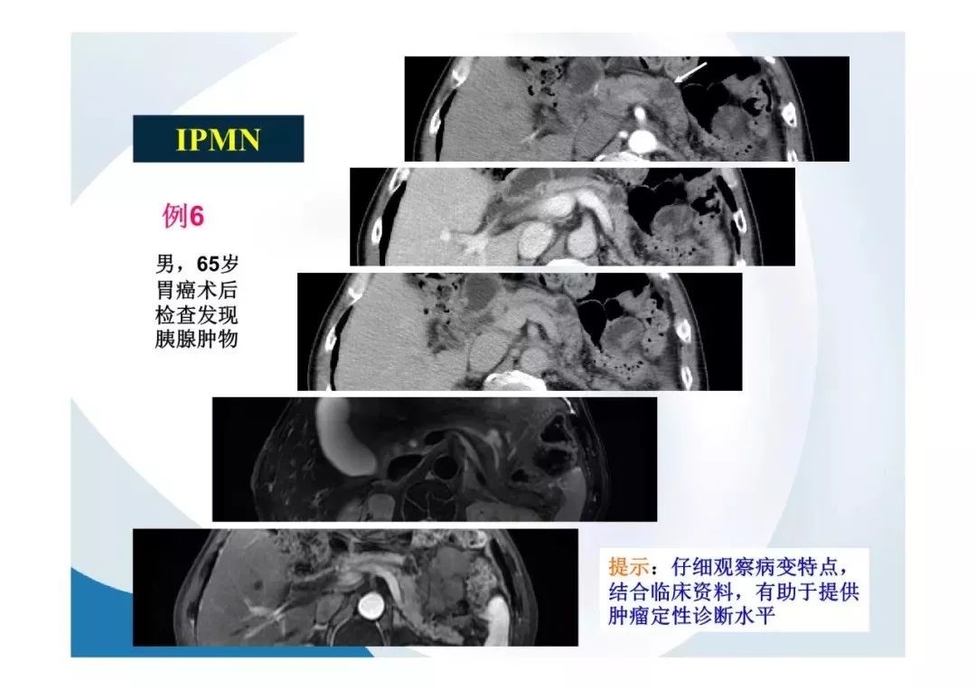 【PPT】胰腺非常见肿瘤影像学检查与诊断思路