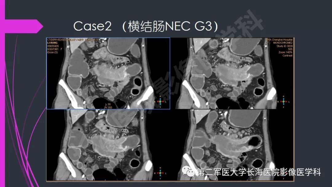 【PPT】肠道神经内分泌肿瘤