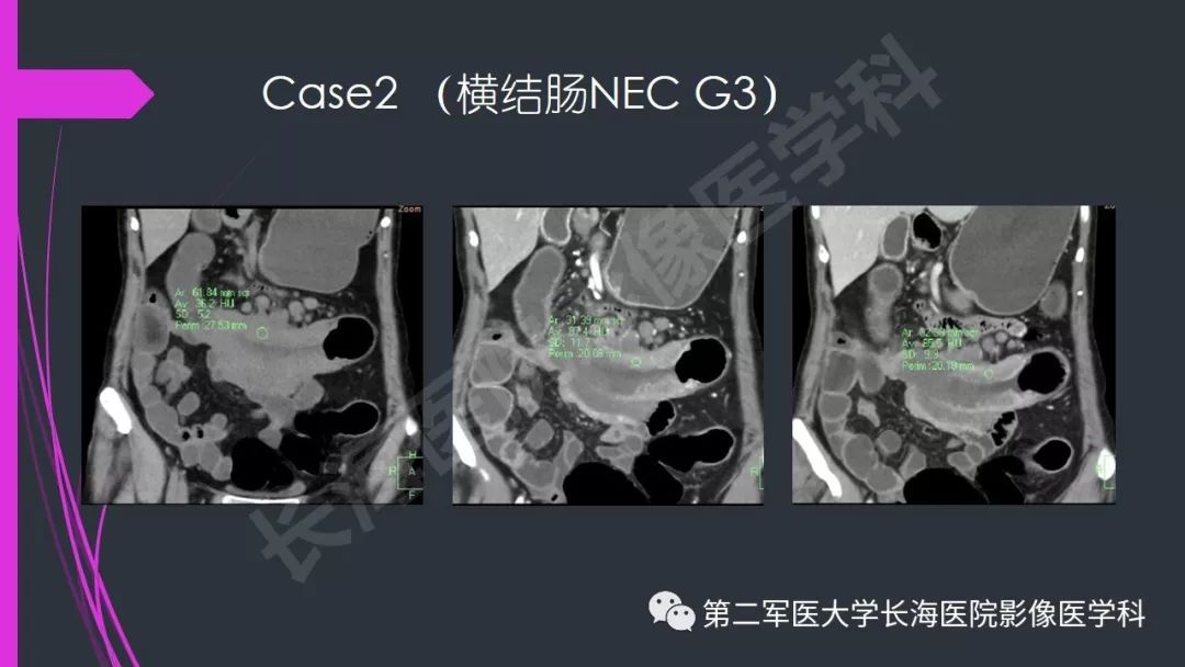 【PPT】肠道神经内分泌肿瘤