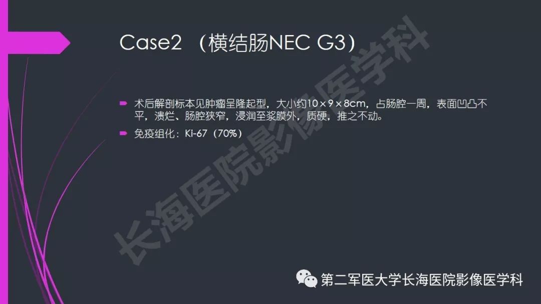 【PPT】肠道神经内分泌肿瘤