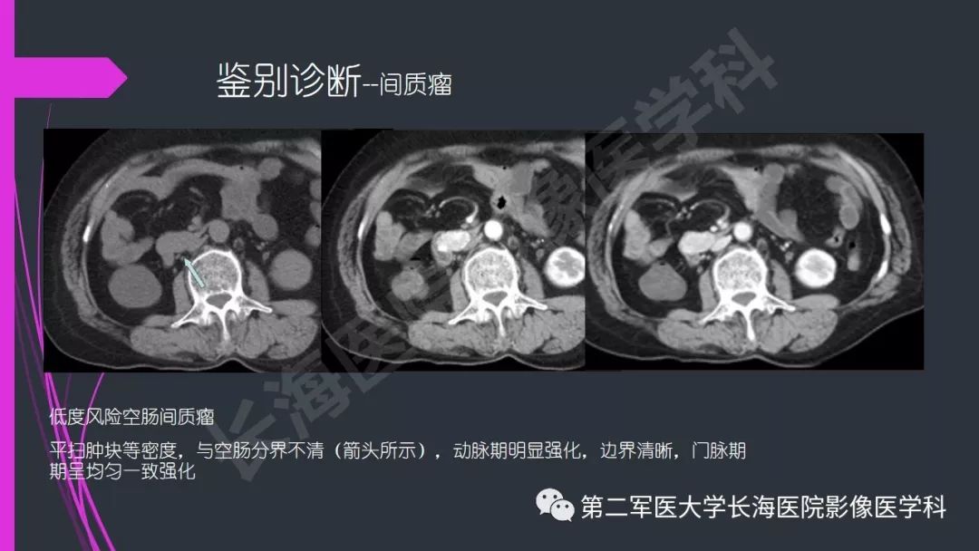 【PPT】肠道神经内分泌肿瘤