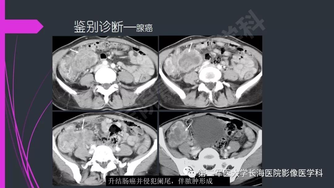 【PPT】肠道神经内分泌肿瘤