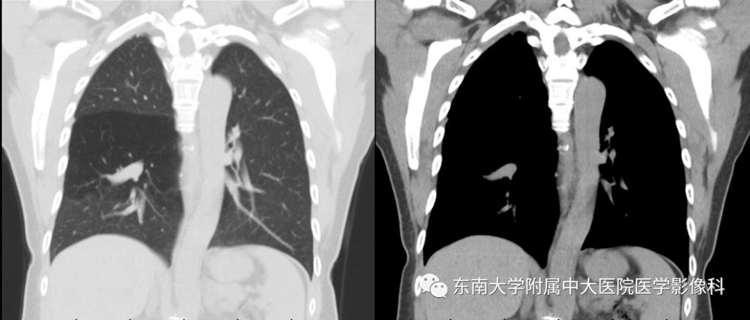 【病例】先天性支气管闭锁2例CT影像