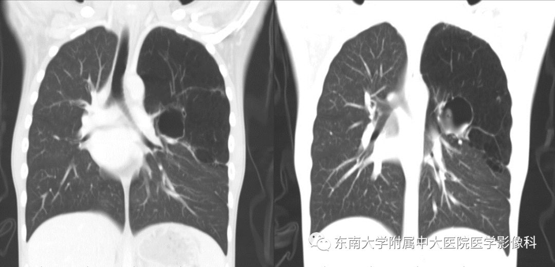 【病例】先天性支气管闭锁2例CT影像