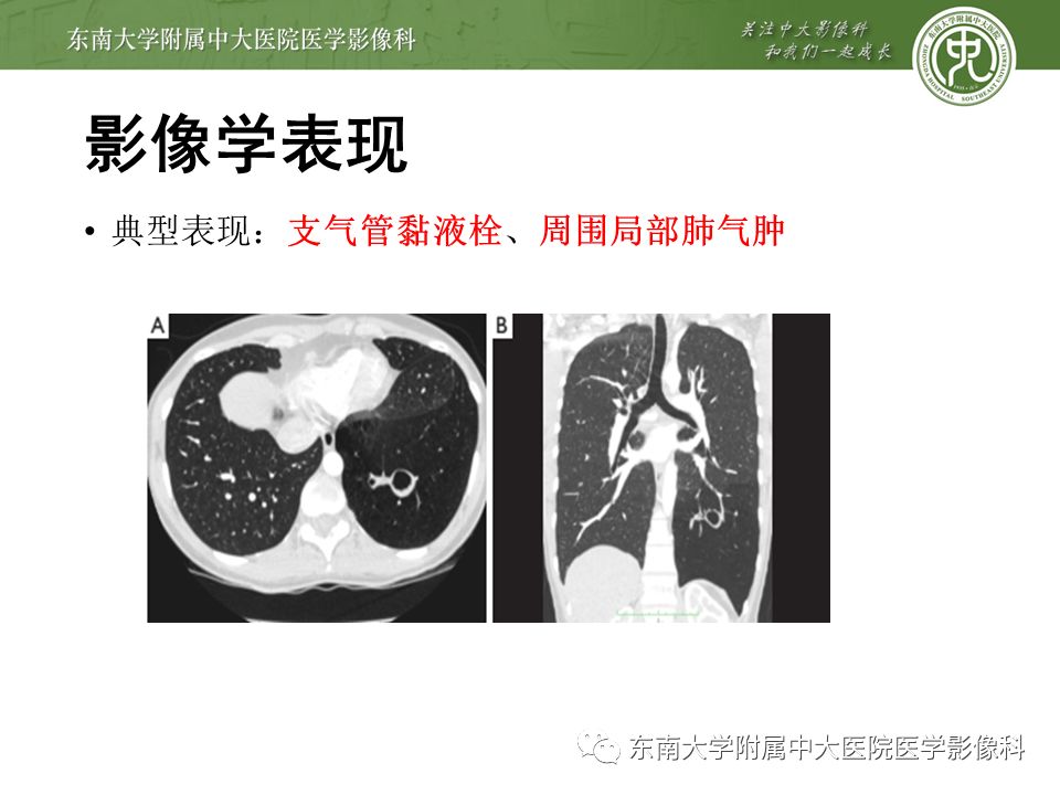 【病例】先天性支气管闭锁2例CT影像