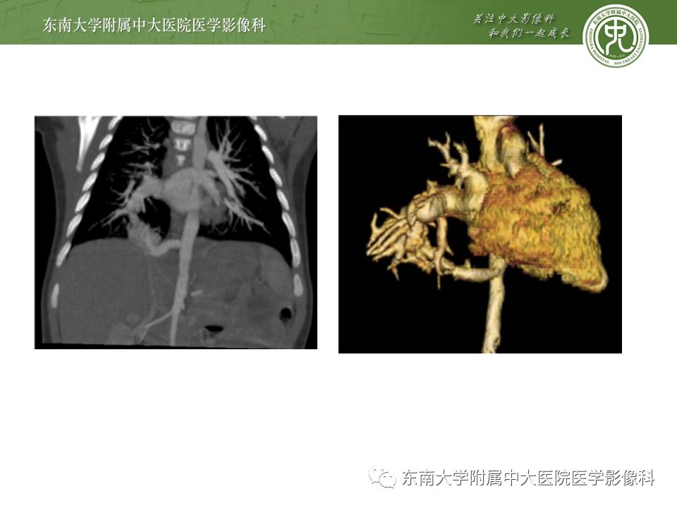 【病例】先天性支气管闭锁2例CT影像