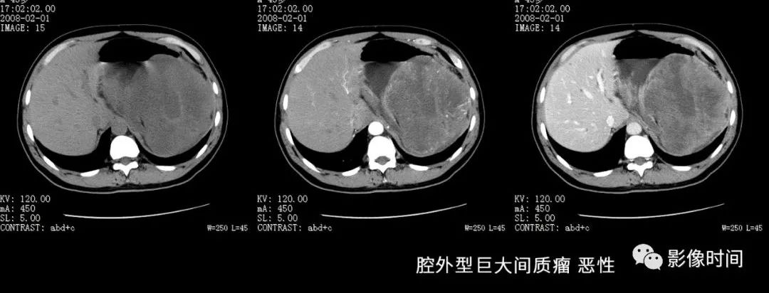 胃神经鞘瘤的 CT表现 胃神经鞘瘤的 CT表现