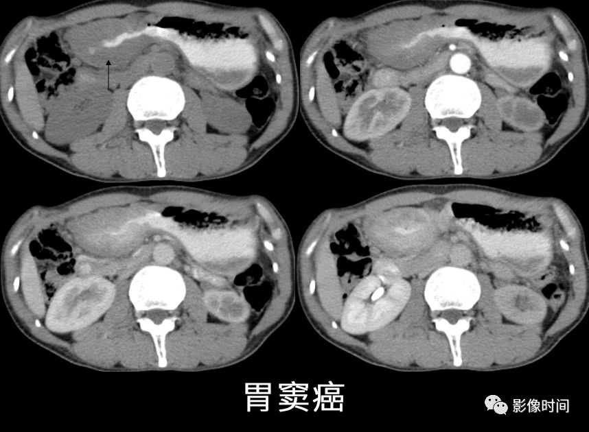 胃神经鞘瘤的 CT表现 胃神经鞘瘤的 CT表现